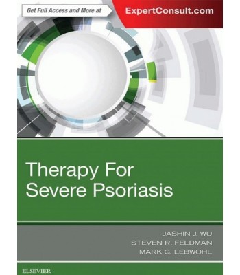 Therapy for Severe Psoriasis