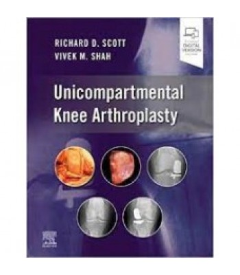 Unicompartmental Knee Arthroplasty
