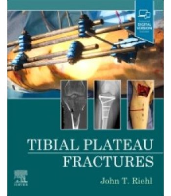 Tibial Plateau Fractures 