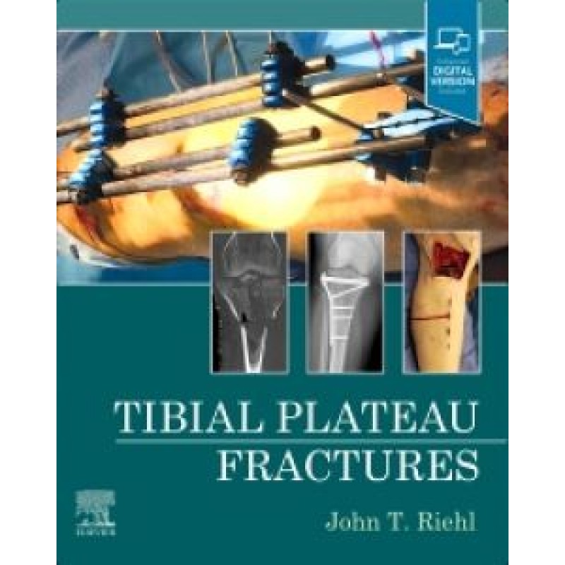 Tibial Plateau Fractures 