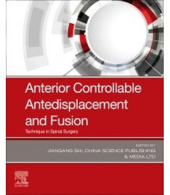 Anterior Controllable Antedisplacement and Fusion, 1st Edition