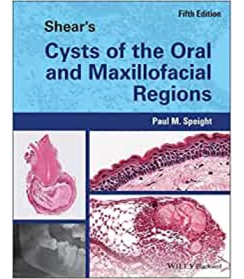 Shear's Cysts of the Oral and Maxillofacial Regions, 5E