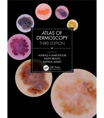 Atlas of Dermoscopy, 3E