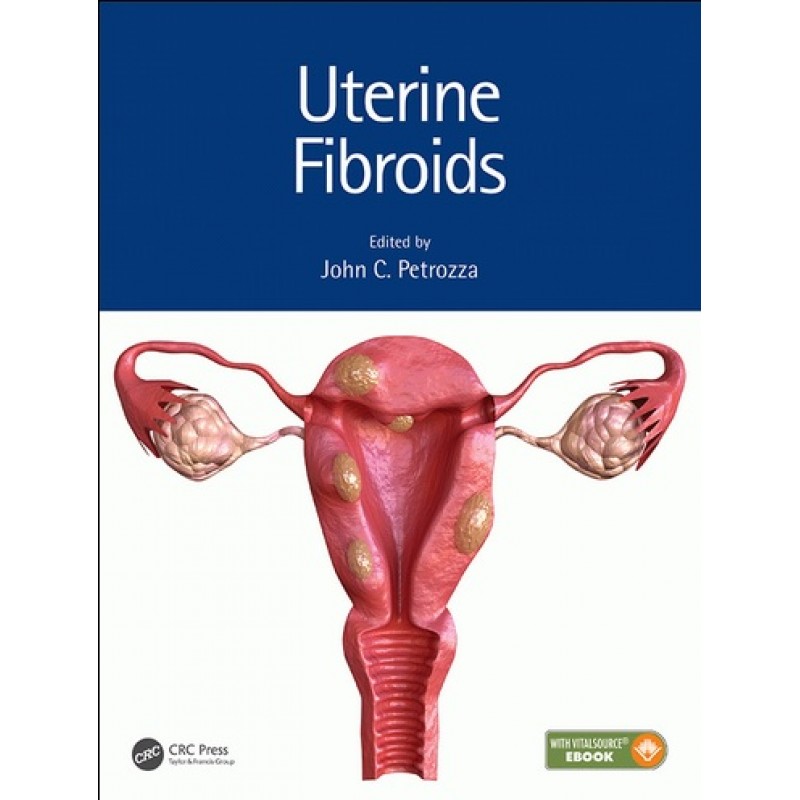 Uterine Fibroids 