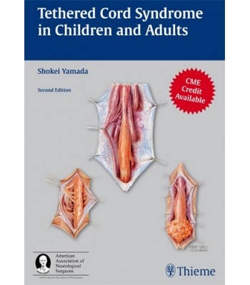 Tethered Cord Syndrome in Children and Adults