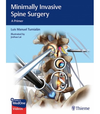 Minimally Invasive Spine Surgery