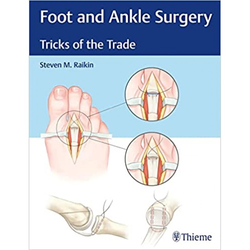 Foot and Ankle Surgery Tricks of the Trade