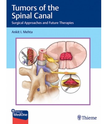  Tumors of the Spinal Canal Surgical Approaches and Future Therapies