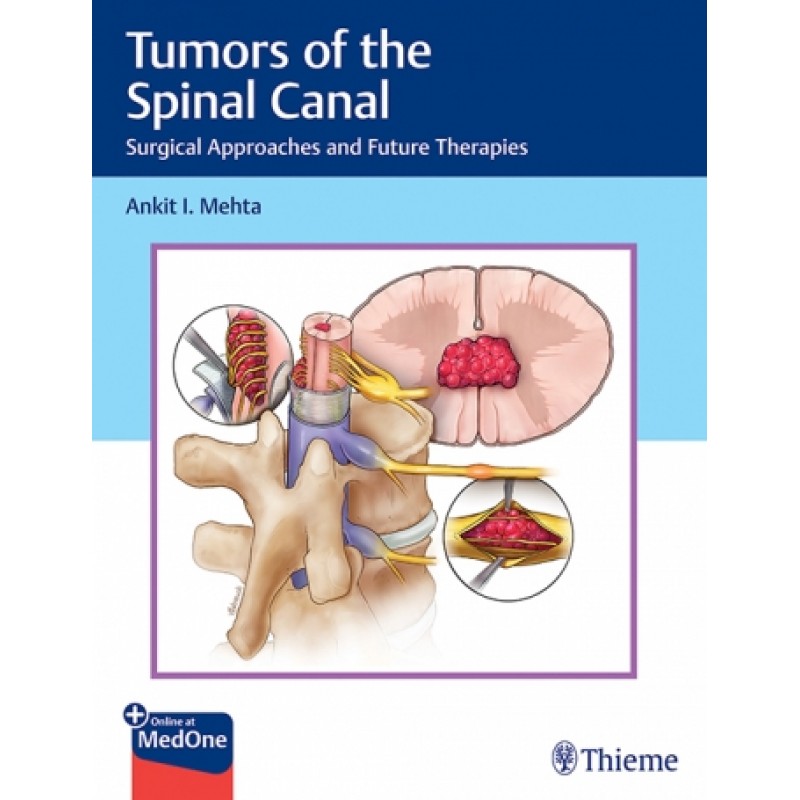  Tumors of the Spinal Canal Surgical Approaches and Future Therapies