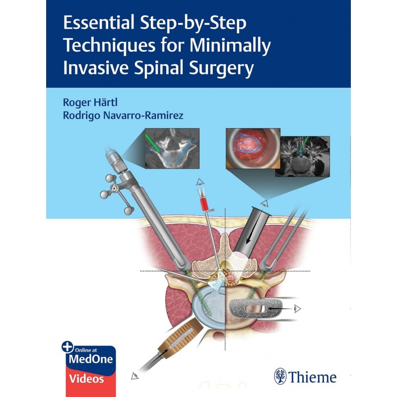 Essential Step-by-Step Techniques for Minimally Invasive Spinal Surgery 