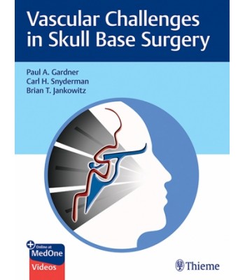 Vascular Challenges in Skull Base Surgery