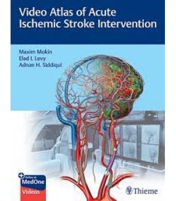 Video Atlas of Acute Ischemic Stroke Intervention