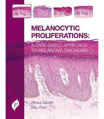 Melanocytic Proliferations