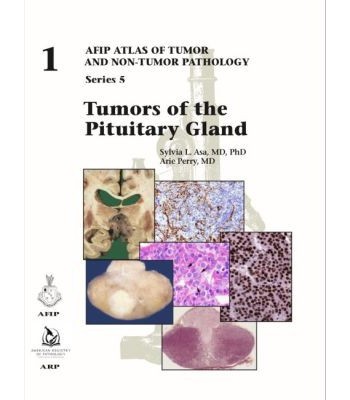 Tumors of the Pituitary Gland