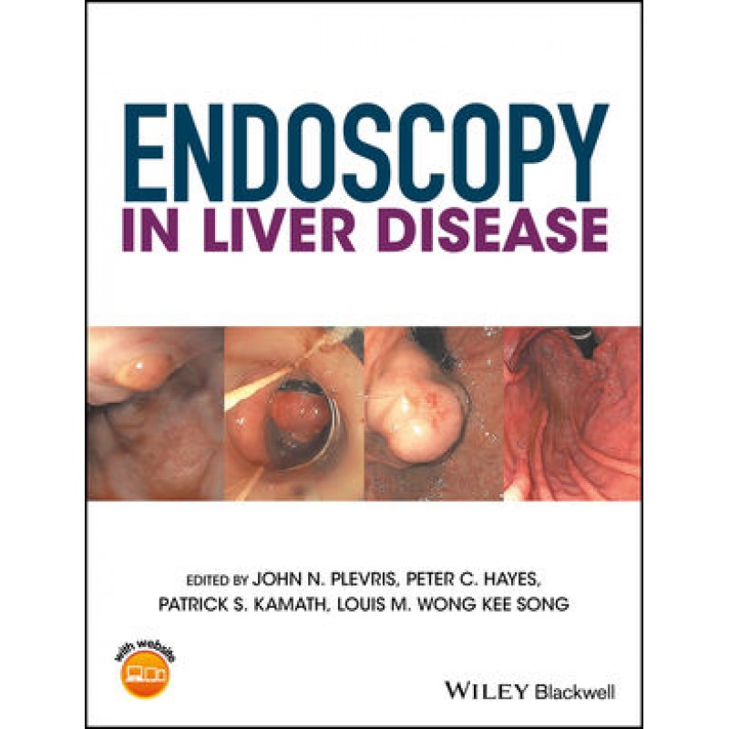 Endoscopy in Liver Disease