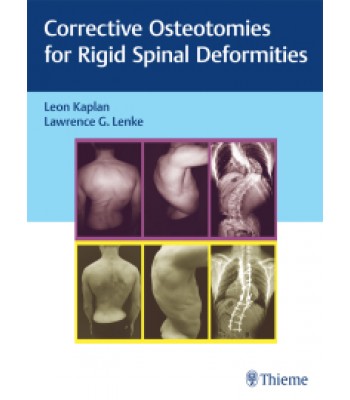 Corrective Osteotomies for Rigid Spinal Deformities