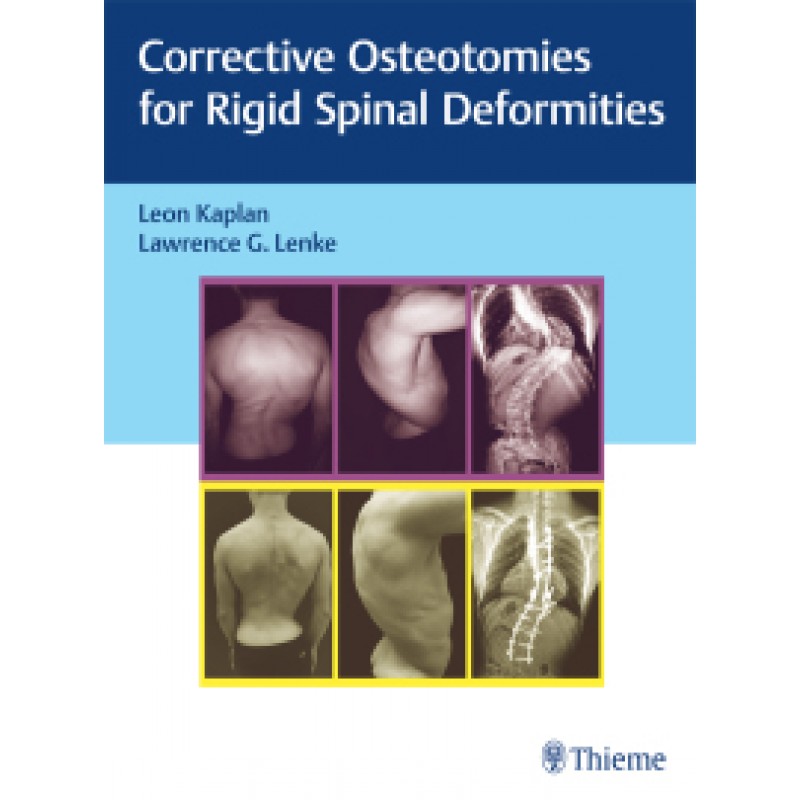 Corrective Osteotomies for Rigid Spinal Deformities