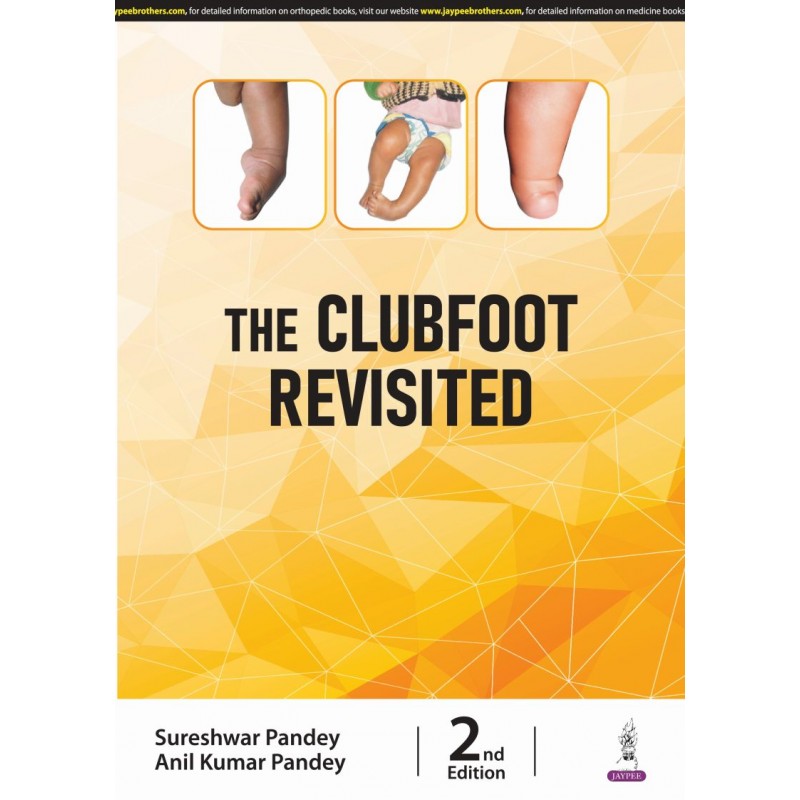 The Clubfoot Revisited