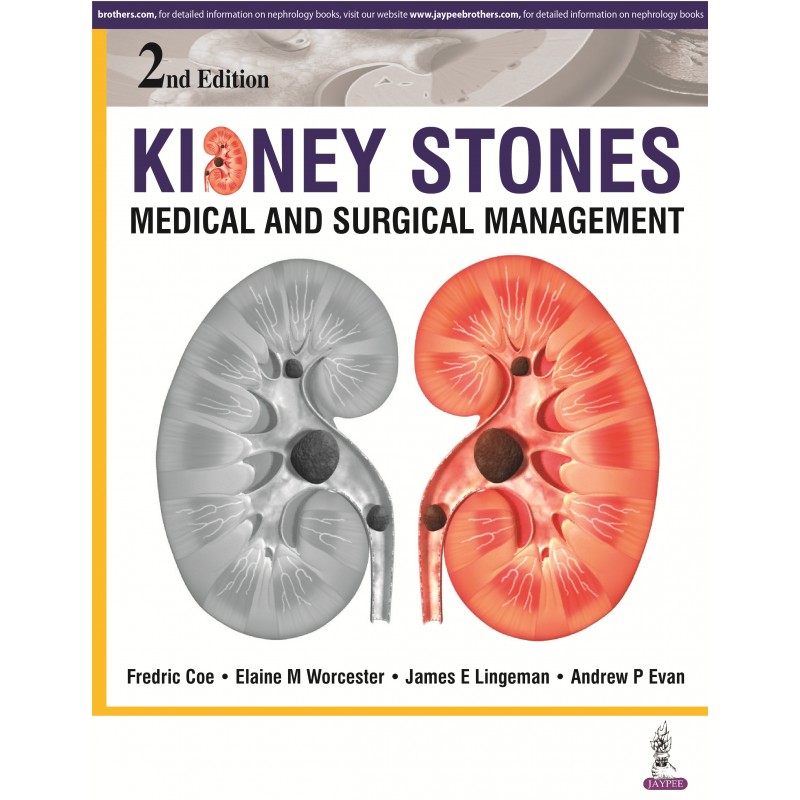 Kidney Stones 2nd Edition