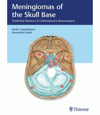 Meningiomas of the Skull Base: Treatment Nuances in Contemporary Neurosurgery