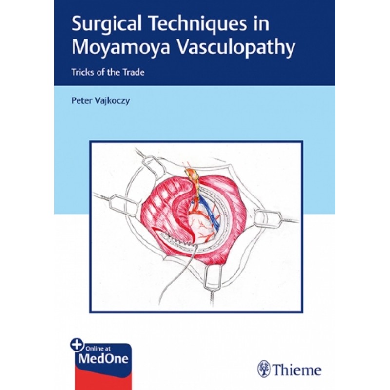 Surgical　Techniques　in　Moyamoya　Vasculopathy