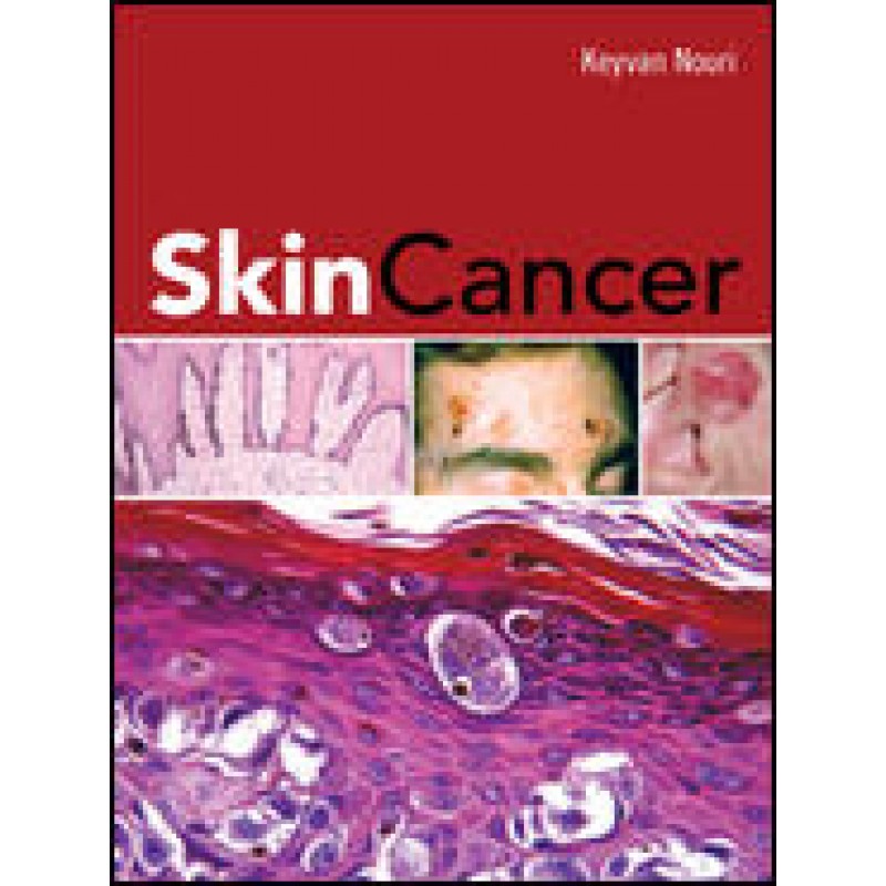 Skin Cancer