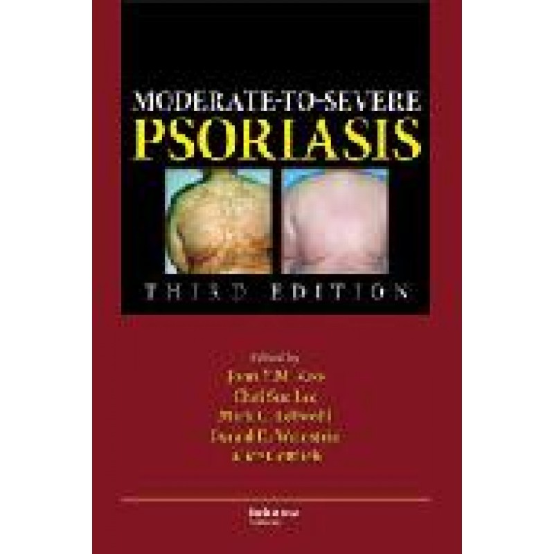 Moderate-to-Severe Psoriasis, Third Edition