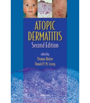 Atopic Dermatitis, Second Edition
