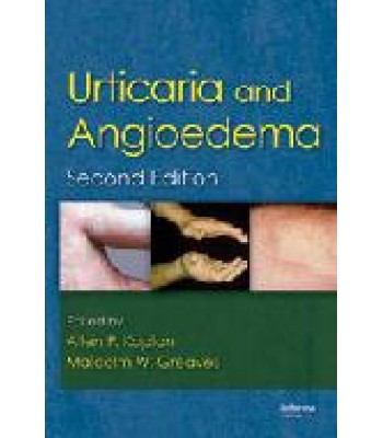 Urticaria and Angioedema, Second Edition