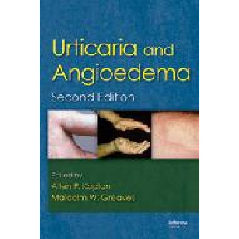 Urticaria and Angioedema, Second Edition