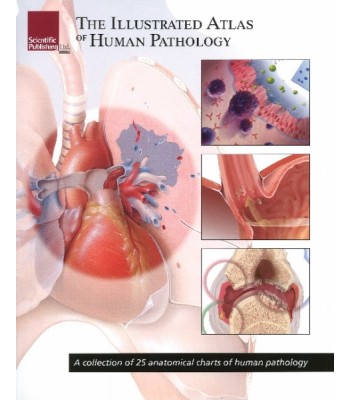 Illustrated Atlas of Human Pathology/ A Collection of 25 Anatomical Charts of Human Pathology
