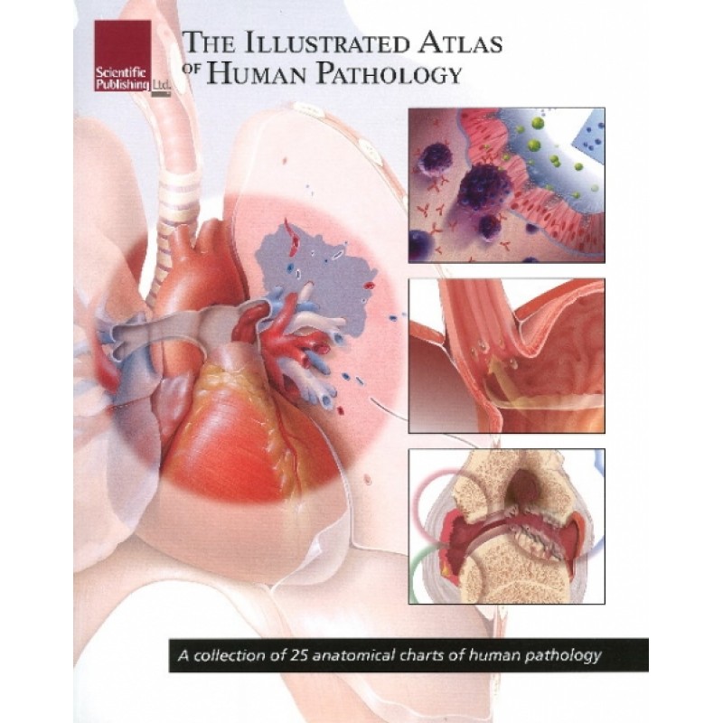 Illustrated Atlas of Human Pathology/ A Collection of 25 Anatomical Charts of Human Pathology