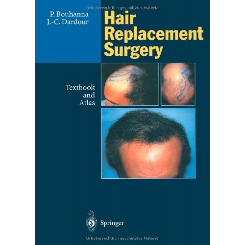 Hair Replacement Surgery: Textbook and Atlas