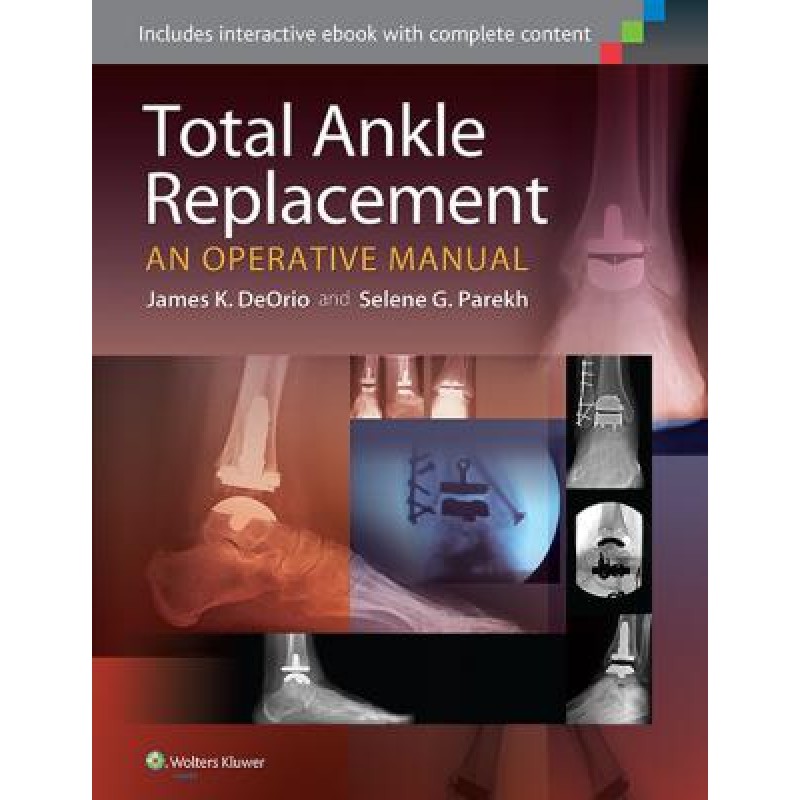 Total Ankle Replacement: An Operative Manual