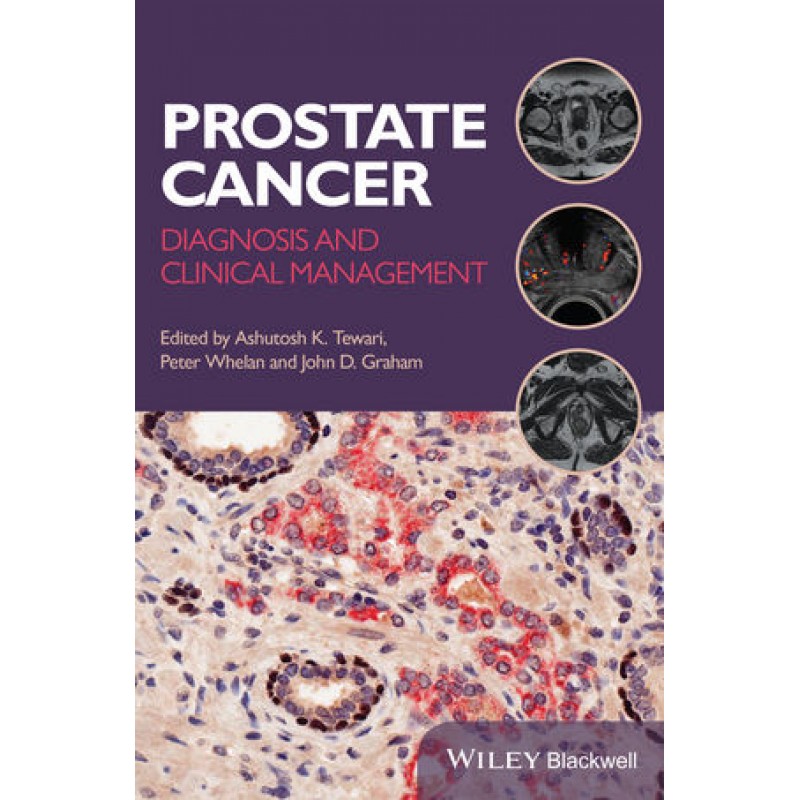 Prostate Cancer: Diagnosis and Clinical Management