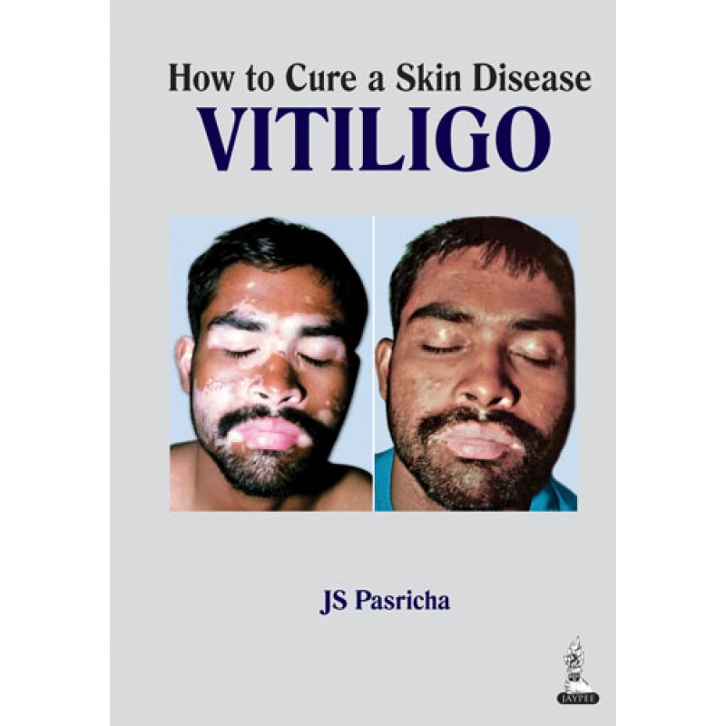How to Cure a Skin Disease: Vitiligo
