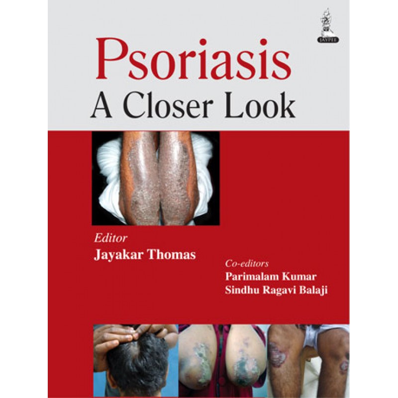 Psoriasis