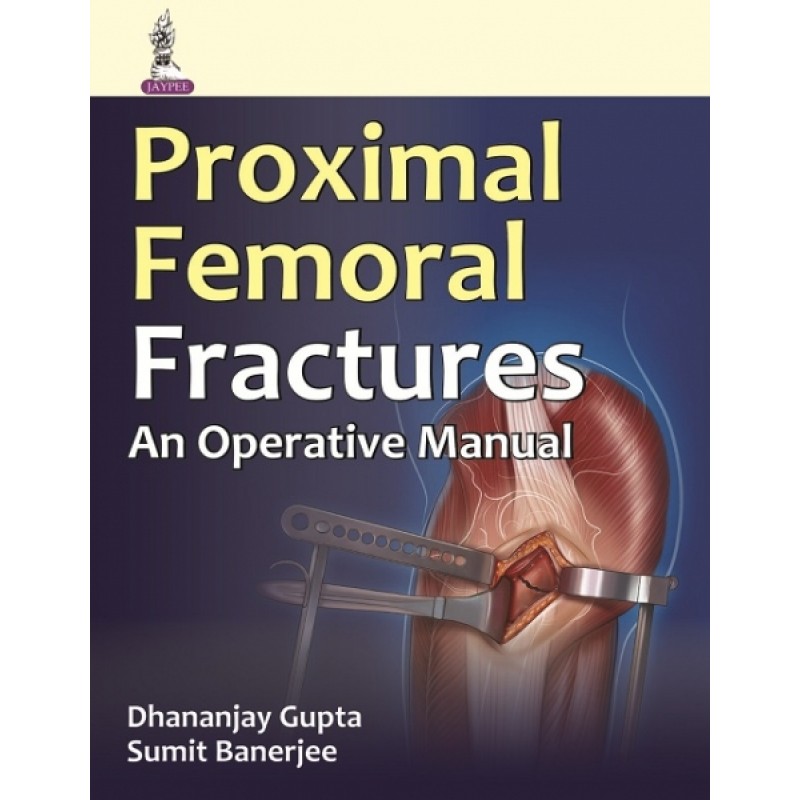 Proximal Femoral Fractures: An Operative Manual
