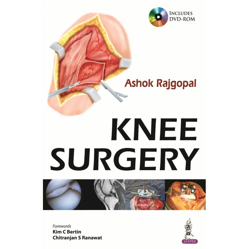 Knee Surgery