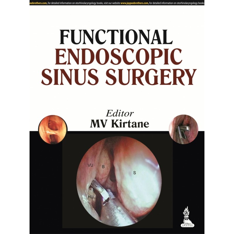 Functional Endoscopic Sinus Surgery