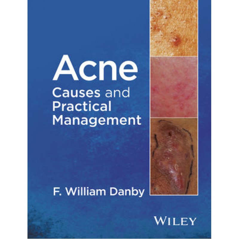 Acne: Causes and Practical Management