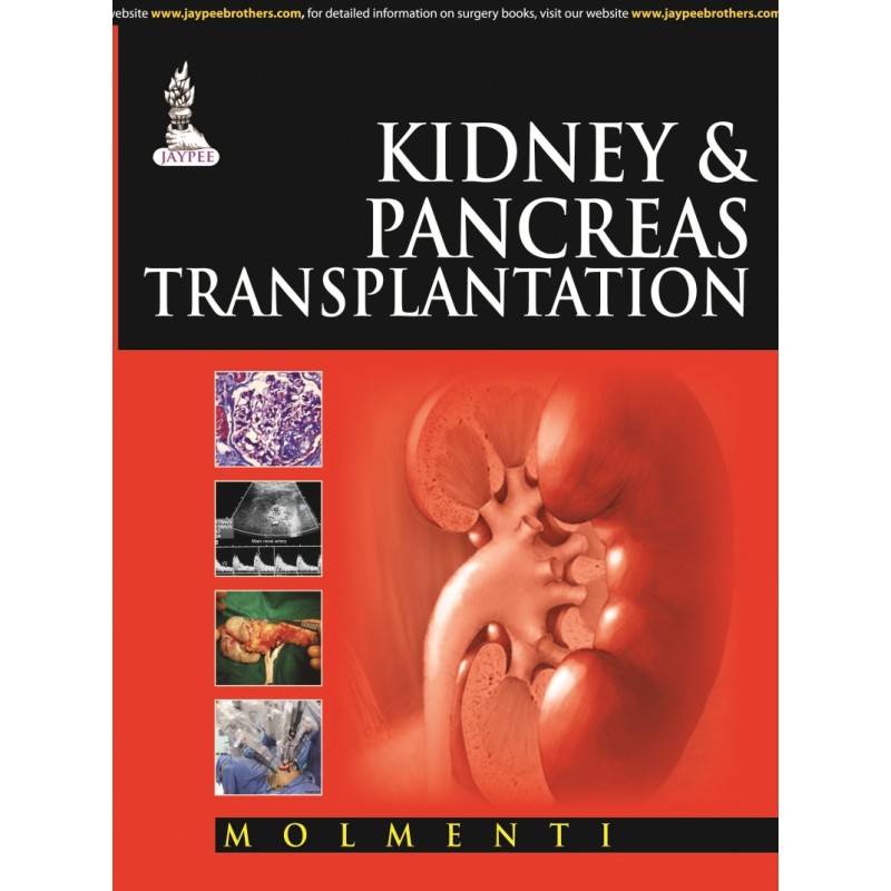 Kidney v and Pancreas Transplantation