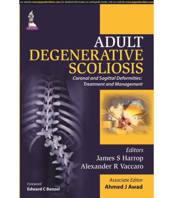 Adult Degenerative Scoliosis