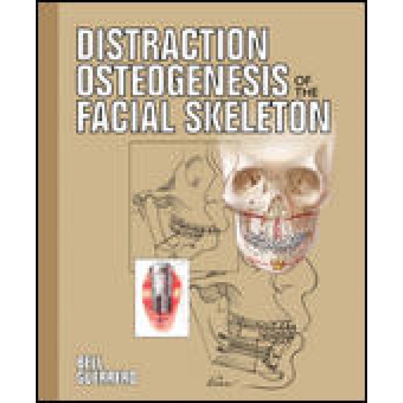 Distraction Osteogenesis of the Facial Skeleton