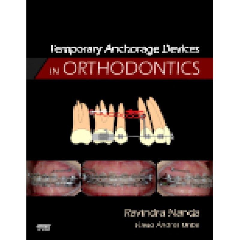 Temporary Anchorage Devices in Orthodontics