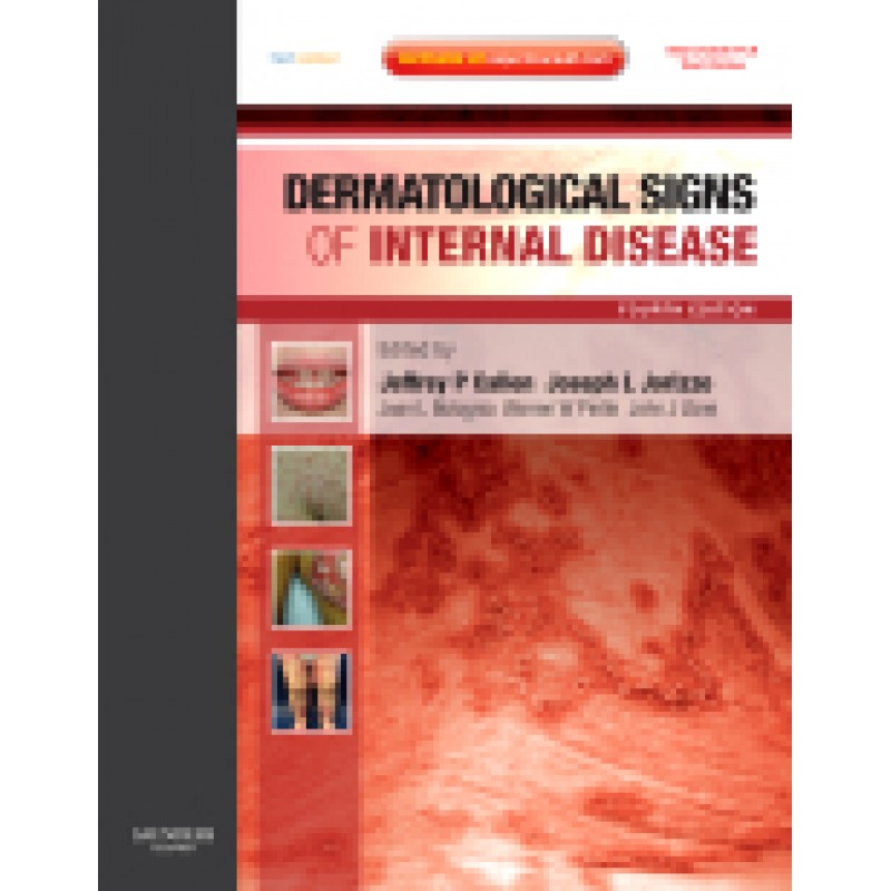 Dermatological Signs of Internal Disease, 4th Edition Expert Consult - Online and Print