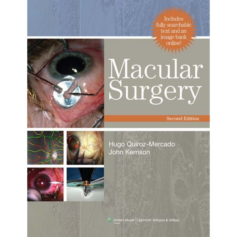 Macular Surgery 2nd edition