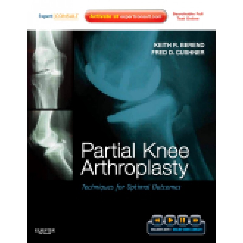 Partial Knee Arthroplasty - Techniques for Optimal Outcomes with DVD - Expert Consult - Online  and  Print