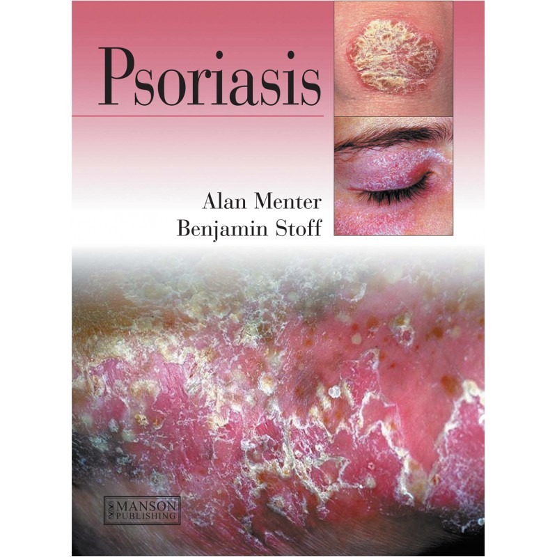 Psoriasis