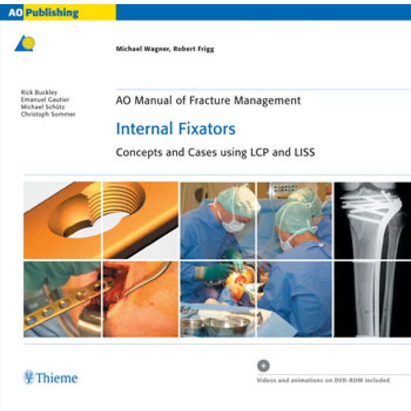 AO Manual of Fracture Management: Internal Fixators